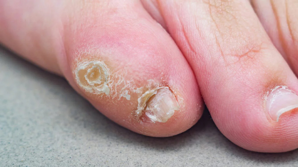Callosidades e hiperqueratosis