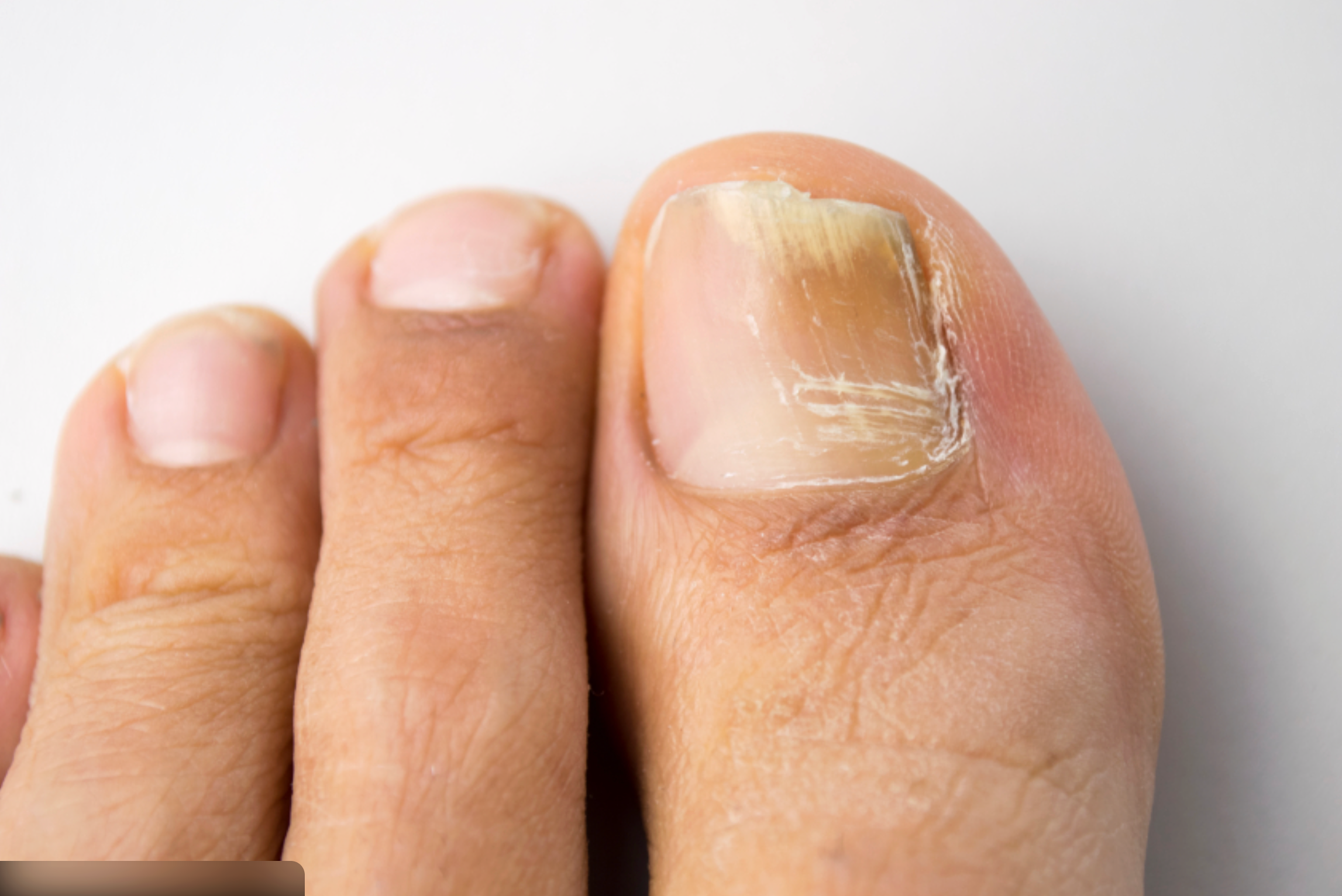 Onicomicosis: hongos en uñas de los pies